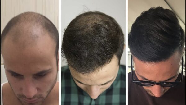 زراعة الشعر في تركيا .. تعرف على 4 مراكز لزراعة الشعر وأهم الأسعار 4 العوامل التى تحدد تكلفة زراعة الشعر في تركيا