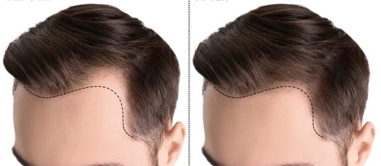 زراعة الشعر في تركيا .. تعرف على 4 مراكز لزراعة الشعر وأهم الأسعار 12 زراعة الشعر في تركيا